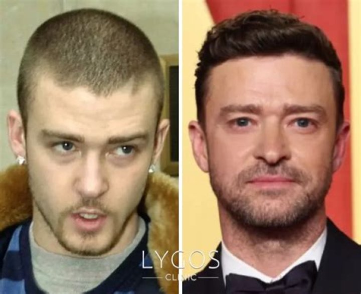 What Happened To Justin Timberlake Hair- Is He Going Bald? Hair Fall Linked With Disease Rumors